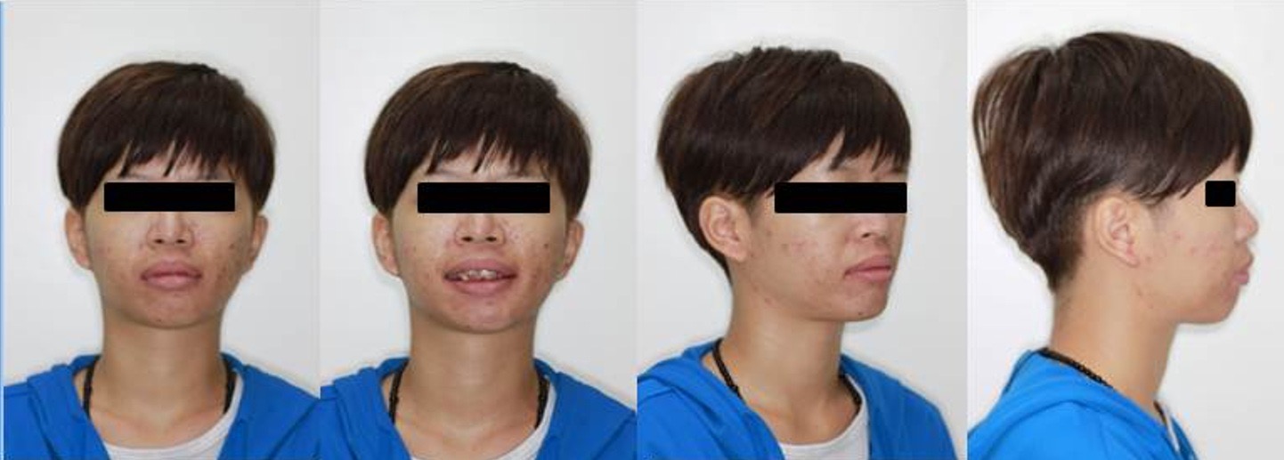 治療前後全口X光對比